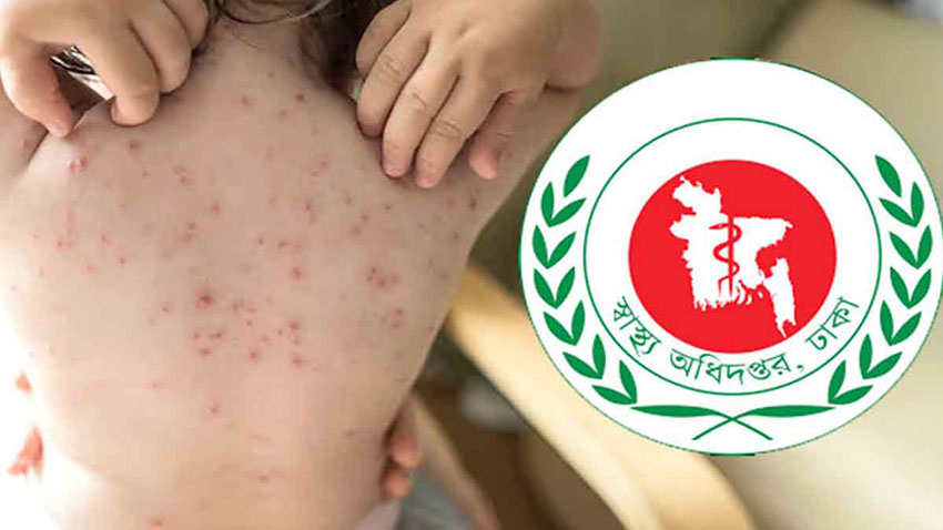 হাম উপসর্গে একদিনে তিনজনের মৃত্যু